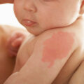 newborn with pale pink birthmark